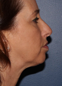 Coolsculpting mini – submental (neck) area after photo. Individual results may vary.