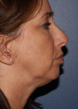 Coolsculpting mini – submental (neck) area before photo. Individual results may vary.