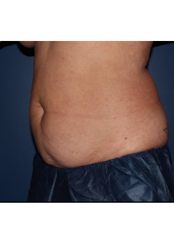 Coolsculpting – abdomen and flanks before photo. Individual results may vary.