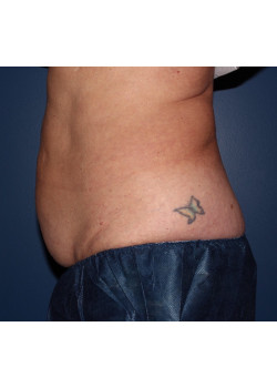Coolsculpting – abdomen and flanks before photo. Individual results may vary.