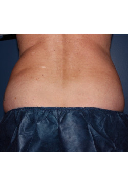 Coolsculpting – abdomen and flanks before photo. Individual results may vary.