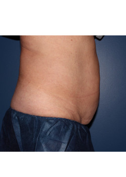 Coolsculpting – abdomen and flanks before photo. Individual results may vary.
