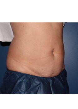 Coolsculpting – abdomen and flanks before photo. Individual results may vary.
