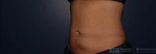 Coolsculpting on abdomen and flanks after photo. Individual results may vary.