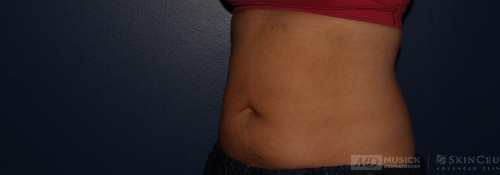 Coolsculpting on abdomen and flanks before photo. Individual results may vary.