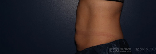 Coolsculpting on abdomen and flanks after photo. Individual results may vary.