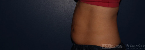 Coolsculpting on abdomen and flanks before photo. Individual results may vary.