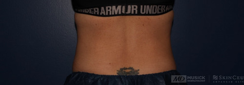 Coolsculpting on abdomen and flanks after photo. Individual results may vary.