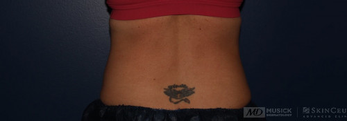 Coolsculpting on abdomen and flanks before photo. Individual results may vary.