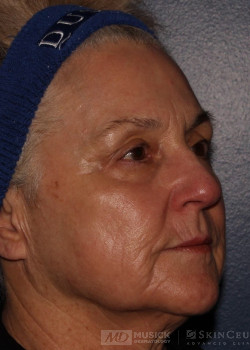 CO2RE Laser after photo. Individual results may vary.
