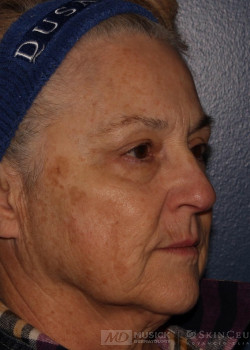 CO2RE Laser before photo. Individual results may vary.
