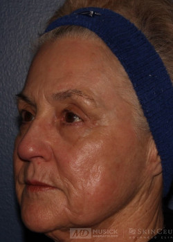 CO2RE Laser after photo. Individual results may vary.