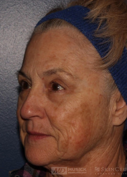 CO2RE Laser before photo. Individual results may vary.