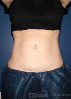 CoolSculpting