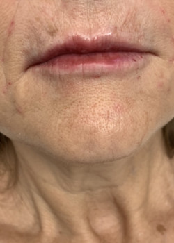 Juvederm