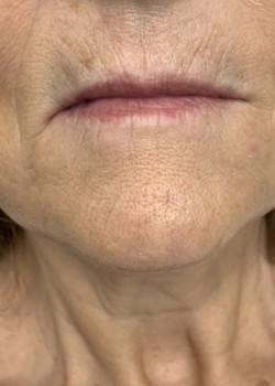 Juvederm