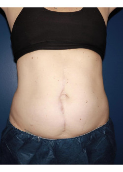 CoolSculpting