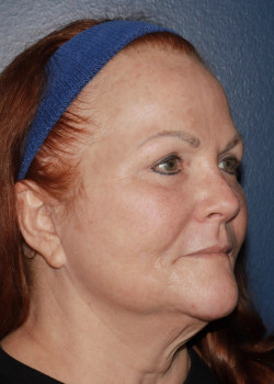 CO2RE Laser after photo. Individual results may vary.