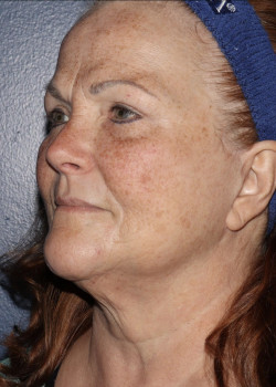 CO2RE Laser before photo. Individual results may vary.