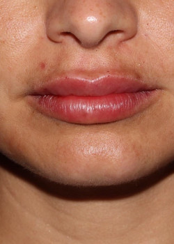 Juvederm