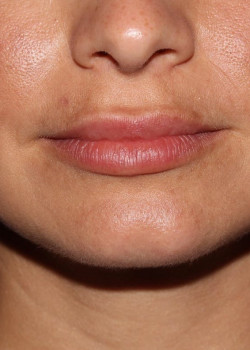 Juvederm