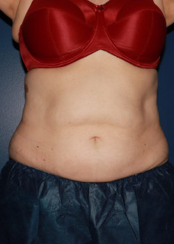 CoolSculpting