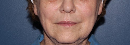 Microneedling