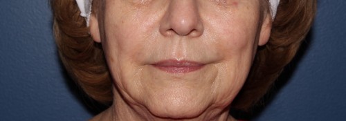 Microneedling